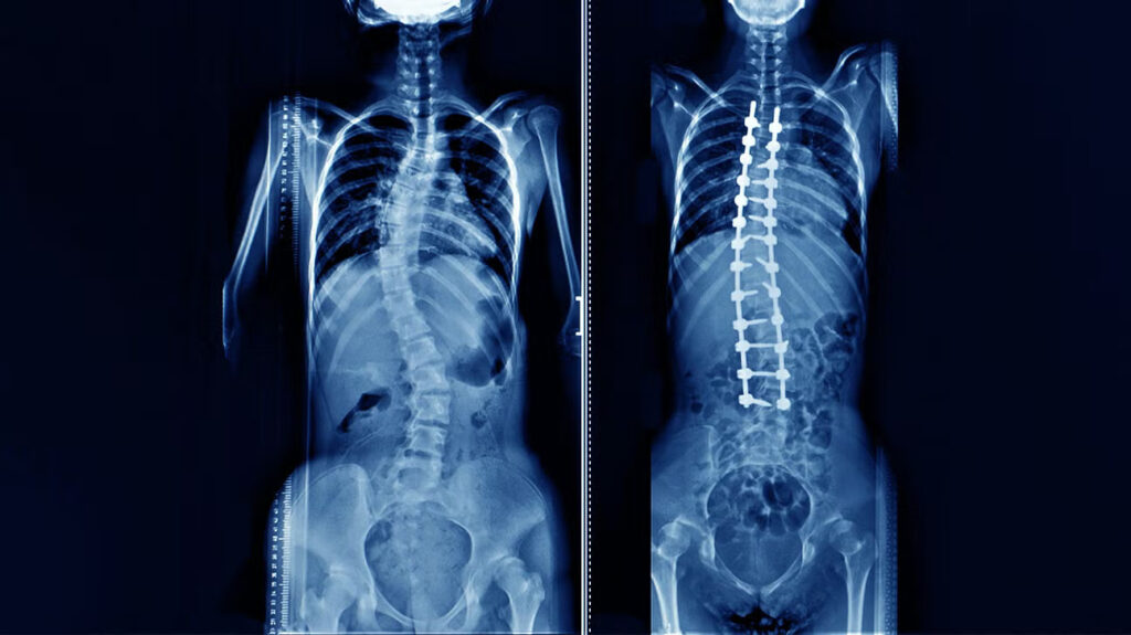 Spine & Scoliosis Surgery